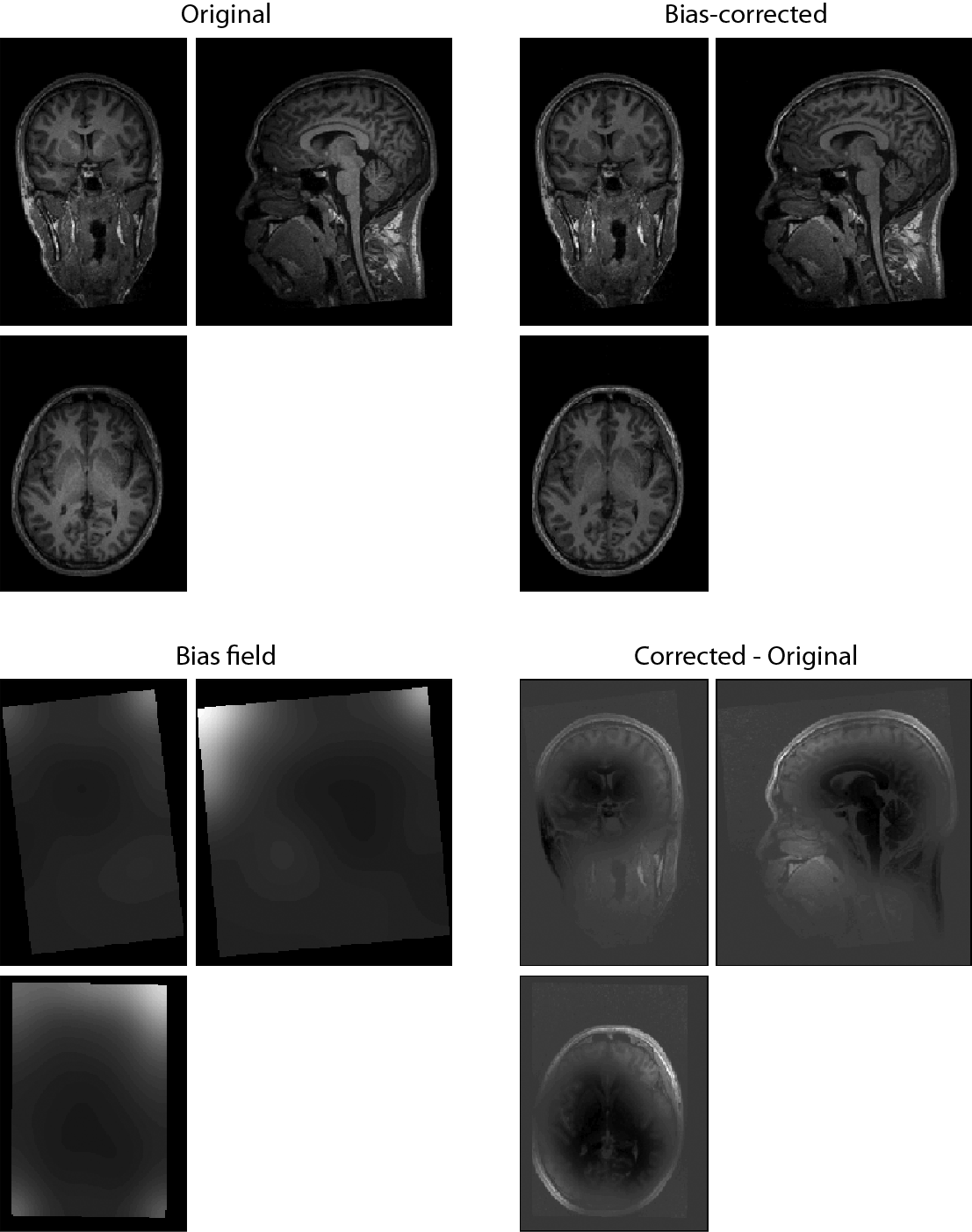 Original T1-weighted MRI image, bias-corrected version, and the estimated bias field