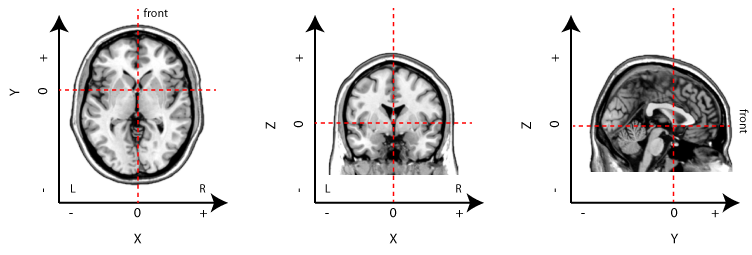 Stereotaxic coordinate system for the human brain