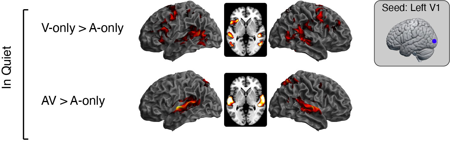 Effective connectivity differences for V-only and AV speech compared to A-only speech