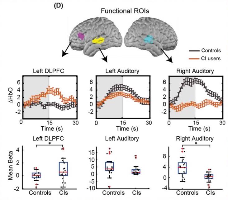 Brain responses for listeners with cochlear implants and controls showing greater frontal activity in CI listeners.